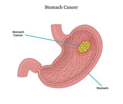 Stomach cancer survivor Ron Dunnahoo first knew something was wrong when he began having severe indigestion. . How i knew i had stomach cancer